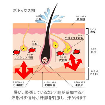 ボトックス前